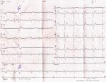 Расшифровка кардиограммы, давление фото 2
