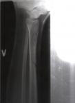 Перелом большеберцовой кости фото 3