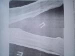 Закрытый перелом костей правого предплечья в нижней трети фото 1