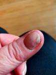 Грибок ногтя на большом пальце руки фото 1