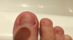 Опух палец на ноге после того, как подстригла ногти фото 2