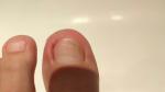 Опух палец на ноге после того, как подстригла ногти фото 1