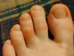 Воспаление и покраснение пальцев ног фото 1