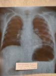 Рентген лёгких, описание фото 2