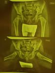 Антеторсия шеек бедренных костей 2 степени, скошенность крыш вертлужных впадин фото 1