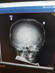 Расшифровать описание рентгена черепа фото 1