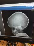 Расшифровать описание рентгена черепа фото 2