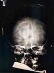 Расшифровать описание рентгена черепа фото 3