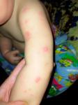 Это аллергия или атопический дерматит? фото 2
