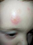 Это аллергия или атопический дерматит? фото 1