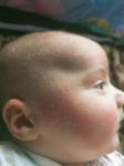 Акне новорожденных, или атопический дерматит? фото 1