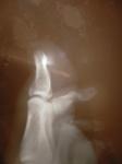 Сломанный палец ноги и гипс фото 2