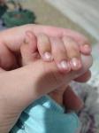 Жалоба на почернение кожи вокруг пальца малыша, ребенку 1,5 месяца фото 2