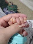 Жалоба на почернение кожи вокруг пальца малыша, ребенку 1,5 месяца фото 1