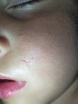 Что делать, чтобы у ребёнка на лице не остался шрам? фото 1