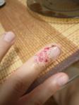 Травма пальца, снят верхний слой кожи фото 1