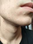 Красные пятна вокруг рта и шелушение фото 2