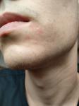 Красные пятна вокруг рта и шелушение фото 1