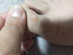 Болячка на пальце ноги фото 1