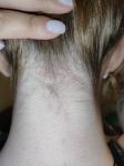 Покраснения на шее у корневой зоны волос сзади фото 1