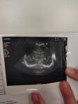 Гидроцефалия у новорождённого фото 5