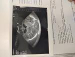 Гидроцефалия у новорождённого фото 3