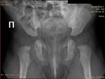 Дисплазия ТБС (рентген) фото 1