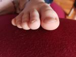 Утолщение ногтя на ноге фото 3