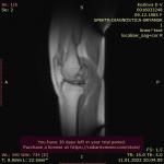 Застарелая спортивная травма колена фото 1
