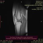 Застарелая спортивная травма колена фото 2