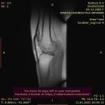 Застарелая спортивная травма колена фото 3