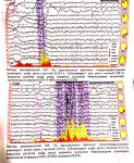 Результат ЭЭГ и наличие аутизма фото 1