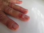 Полупрозрачная шишка возле ногтя на пальце руки фото 1