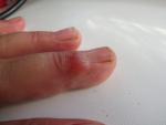Полупрозрачная шишка возле ногтя на пальце руки фото 3