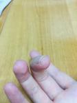 Трещины и шелушение на подушечках пальцев фото 1