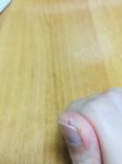 Трещины и шелушение на подушечках пальцев фото 3