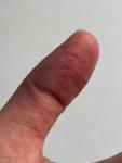 Кожа на пальцах рук при сд1 фото 2