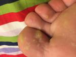 Сыпь на пальцах ноги фото 2