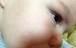 Не могу вылечить аллергию у младенца, с полуторамесячного возраста! фото 1