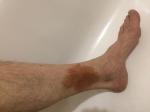 Коричневое пятно на ноге после перелома голеностопного сустава фото 1