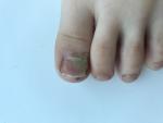Травма ногтя фото 1