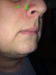 Покраснения нос фото 2
