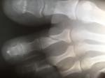 Сложный перелом второго пальца левой ноги фото 4