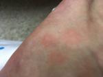 Красные пятна на коже (преимущественно ноги (бедра) фото 3