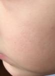Рубцы на лице от аллергии фото 1