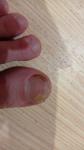 Изменение ногтя на большом пальце фото 3