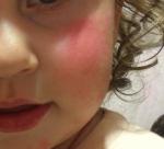 У ребёнка шелушащееся пятна на лице, помогите пожалуйста фото 3