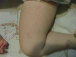 Сыпь у ребека распространяется с рук на лицо и бедра фото 5