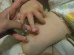 Сыпь у ребека распространяется с рук на лицо и бедра фото 3