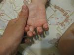Сыпь у ребека распространяется с рук на лицо и бедра фото 4